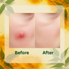 Before and after close-up of skin showing healing effect using Best Acne Pimple Patches